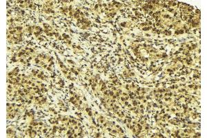 ABIN6272898 at 1/100 staining Human breast cancer tissue by IHC-P.