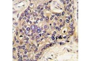 IHC analysis of FFPE human hepatocarcinoma tissue stained with HGF antibody