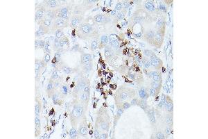 Immunohistochemistry of paraffin-embedded human liver cancer using CD45 Rabbit pAb (ABIN3022953, ABIN3022954, ABIN3022955, ABIN1513451 and ABIN6219315) at dilution of 1:50 (40x lens).