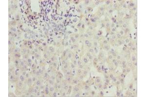 Immunohistochemistry of paraffin-embedded human liver cancer using ABIN7176529 at dilution of 1:100 (ZNF785 Antikörper  (AA 1-200))
