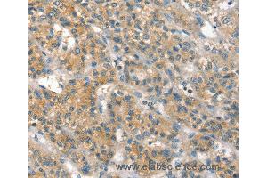 Immunohistochemistry of Human liver cancer using PPP2CA Polyclonal Antibody at dilution of 1:35 (PPP2CA Antikörper)