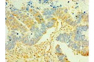 Immunohistochemistry of paraffin-embedded human ovarian cancer using ABIN7158358 at dilution of 1:100 (LIMK2 Antikörper  (AA 1-240))