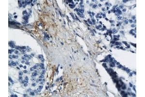 Formalin-fixed and paraffin embedded human breast cancer labeled with Anti MT-ND6 Polyclonal Antibody, Unconjugated  followed by conjugation to the secondary antibody and DAB staining (MT-ND6 Antikörper  (AA 51-150))