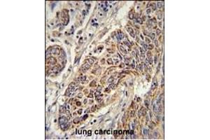 CYC1 Antibody (C-term) (ABIN651531 and ABIN2840281) immunohistochemistry analysis in formalin fixed and paraffin embedded human lung carcinoma followed by peroxidase conjugation of the secondary antibody and DAB staining. (Cytochrome C1 Antikörper  (C-Term))