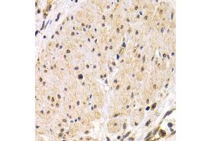 Immunohistochemistry of paraffin-embedded human stomach cancer using TMPRSS2 antibody at dilution of 1:200 (400x lens). (TMPRSS2 Antikörper)