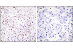 Immunohistochemistry analysis of paraffin-embedded human breast carcinoma tissue, using SENP3 Antibody. (SENP3 Antikörper  (AA 10-59))