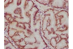 IHC image of ABIN7127346 diluted at 1:115. (Rekombinanter ATF2 Antikörper)