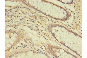 Immunohistochemistry of paraffin-embedded human colon cancer using ABIN7172148 at dilution of 1:100 (THRA Antikörper  (AA 1-490))