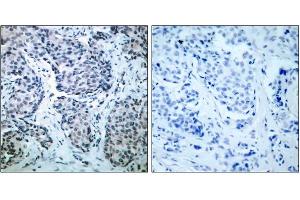 Immunohistochemical analysis of paraffin-embedded human breast carcinoma tissue, using SEK1/MKK4(phospho-Thr261)antibody (E011176). (MAP2K4 Antikörper  (pThr261))