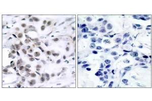 Immunohistochemical analysis of paraffin-embedded human breast carcinoma tissue using Chk1 (Ab-317) antibody (E021114). (CHEK1 Antikörper)