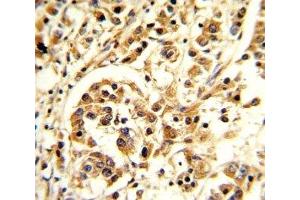 IHC analysis of FFPE human breast carcinoma stained with IL-12 antibody (IL12 Antikörper  (AA 168-195))