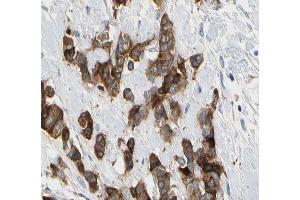 ABIN6266575 at 1/200 staining human breast carcinoma tissue sections by IHC-P. (Cytokeratin 7 Antikörper  (C-Term))