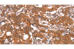 Immunohistochemistry of paraffin-embedded Human gastric cancer using FUT1 Polyclonal Antibody at dilution of 1:30 (FUT1 Antikörper)
