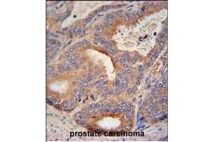 GLB1L2 antibody (C-term) (ABIN654822 and ABIN2844495) immunohistochemistry analysis in formalin fixed and paraffin embedded human prostate carcinoma followed by peroxidase conjugation of the secondary antibody and DAB staining. (GLB1L2 Antikörper  (C-Term))