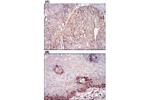 Immunohistochemical staining of human ovarian cancer tissues (A) and esophageal tissues (B) with FTL monoclonal antibody, clone 6E10E4  at 1:200-1:1000 dilution. (FTL Antikörper)