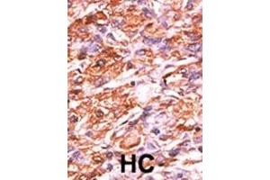 Formalin-fixed and paraffin-embedded human cancer tissue reacted with the primary antibody, which was peroxidase-conjugated to the secondary antibody, followed by AEC staining. (Retinoblastoma 1 Antikörper  (pSer811))