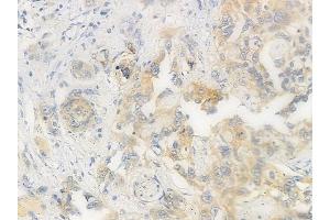 ABIN6256377 and ABIN6267565 at 1/100 staining human tongue carcinoma by IHC-P. (14-3-3 zeta Antikörper  (pSer58))