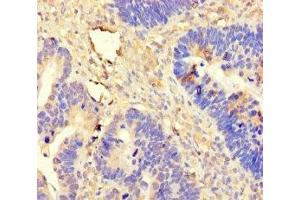 Immunohistochemistry of paraffin-embedded human ovarian cancer using ABIN7144980 at dilution of 1:100 (DDX19A Antikörper  (AA 1-478))