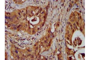 IHC image of ABIN7155827 diluted at 1:300 and staining in paraffin-embedded human cervical cancer performed on a Leica BondTM system.