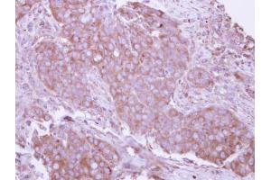 IHC-P Image Immunohistochemical analysis of paraffin-embedded human breast cancer, using CD27, antibody at 1:250 dilution.