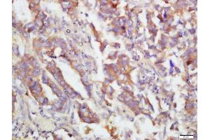 Formalin-fixed and paraffin embedded human lung carcinoma labeled with Rabbit Anti-MKK3(Ser218)/MKK6(Ser207) Polyclonal Antibody, Unconjugated  at 1:200 followed by conjugation to the secondary antibody and DAB staining (MAP2K3 Antikörper  (pSer207))