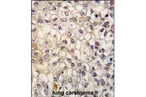 Formalin-fixed and paraffin-embedded human lung carcinoma tissue reacted with CYP2F1 antibody , which was peroxidase-conjugated to the secondary antibody, followed by DAB staining. (CYP2F1 Antikörper  (C-Term))