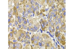 Immunohistochemistry of paraffin-embedded Human liver cancer using MAGED1 Polyclonal Antibody at dilution of 1:100 (40x lens). (MAGED1 Antikörper)