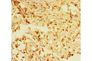 Immunohistochemistry of paraffin-embedded human melanoma using ABIN7166648 at dilution of 1:100 (ACOT6 Antikörper  (AA 1-207))