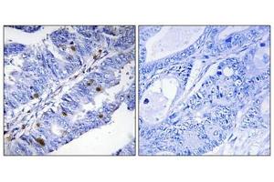 Immunohistochemical analysis of paraffin-embedded human colon carcinoma tissue using Nuclear Receptor NR4A1 (Phospho-Ser351) antibody (left)or the same antibody preincubated with blocking peptide (right). (NR4A1 Antikörper  (pSer351))