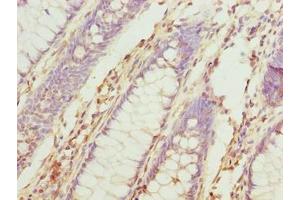 Immunohistochemistry of paraffin-embedded human colon cancer using ABIN7173695 at dilution of 1:100 (TUBb6 Antikörper  (AA 1-446))