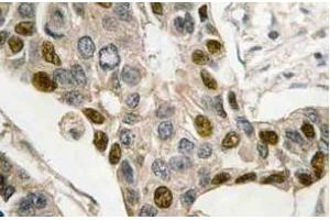 Immunohistochemistry (IHC) analyzes of c-Myb antibody in paraffin-embedded human breast carcinoma tissue.