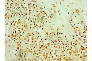 Immunohistochemistry of paraffin-embedded human breast cancer using ABIN7165774 at dilution of 1:100 (MTDH Antikörper  (AA 1-260))