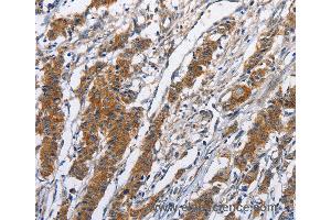 Immunohistochemistry of Human thyroid cancer using NCAPD3 Polyclonal Antibody at dilution of 1:50 (NCAPD3 Antikörper)