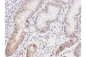 IHC-P Image Immunohistochemical analysis of paraffin-embedded human gastric cancer, using DLD, antibody at 1:100 dilution. (DLD Antikörper)