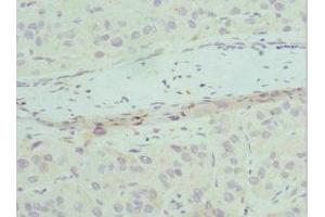 Immunohistochemistry of paraffin-embedded human liver cancer using ABIN7147523 at dilution of 1:100 (CHMP2B Antikörper  (AA 1-213))