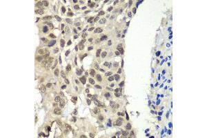 Immunohistochemistry of paraffin-embedded human esophageal cancer using SSRP1 antibody at dilution of 1:100 (x40 lens). (SSRP1 Antikörper)