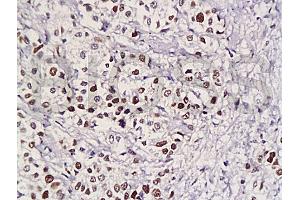 Formalin-fixed and paraffin embedded human gastric carcinoma with Anti-Pokemon Polyclonal Antibody, Unconjugated (ABIN729448) at 1:200, followed by conjugation to the secondary antibody and DAB staining (ZBTB7A Antikörper  (AA 151-250))