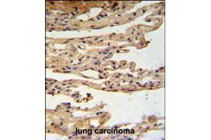 FKBPL Antibody IHC analysis in formalin fixed and paraffin embedded lung carcinoma followed by peroxidase conjugation of the secondary antibody and DAB staining. (FKBPL Antikörper  (C-Term))