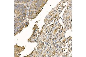 Immunohistochemistry of paraffin-embedded human colon carcinoma using GSDMD (Full Length+N terminal) Rabbit pAb  at dilution of 1:100 (40x lens). (GSDMD Antikörper)