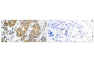 Immunohistochemical analysis of paraffin- embedded human breast carcinoma tissue using GSK3α (Ab-21) antibody (E021007). (GSK3 alpha Antikörper)