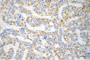 Immunohistochemistry was performed on paraffin-embedded human hepatocarcinoma using VPS28 antibody (ABIN7800926), 1:200).
