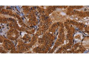 Immunohistochemistry of paraffin-embedded Human thyroid cancer tissue using WDR83 Polyclonal Antibody at dilution 1:60 (MORG1 Antikörper)