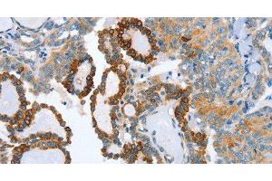 Immunohistochemistry of paraffin-embedded Human thyroid cancer tissue using AIP Polyclonal Antibody at dilution 1:80 (AIP Antikörper)