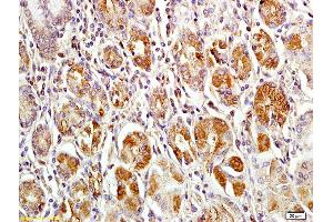 Formalin-fixed and paraffin embedded human gastric carcinoma labeled with Anti-MACC1 Polyclonal Antibody, Unconjugated (ABIN706526) at 1:200 followed by conjugation to the secondary antibody and DAB staining (MACC1 Antikörper  (AA 761-852))