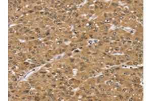 The image on the left is immunohistochemistry of paraffin-embedded Human liver cancer tissue using ABIN7192565(SMC6 Antibody) at dilution 1/30, on the right is treated with synthetic peptide. (SMC6 Antikörper)