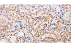 Immunohistochemistry of paraffin-embedded Human thyroid cancer tissue using MAP3K12 Polyclonal Antibody at dilution 1:30 (MAP3K12 Antikörper)