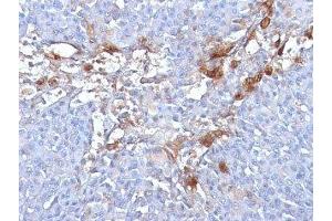 Formalin-fixed, paraffin-embedded human melanoma stained with CD146 antibody (MUC18/1130) (MCAM Antikörper)