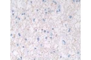 Detection of IL28A in Human Glioma Tissue using Monoclonal Antibody to Interleukin 28A (IL28A) (IL28A Antikörper  (AA 26-200))