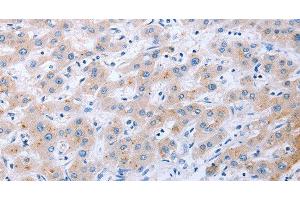 Immunohistochemistry of paraffin-embedded Human liver cancer tissue using FGF4 Polyclonal Antibody at dilution 1:40