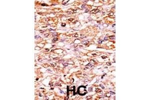 Formalin-fixed and paraffin-embedded human hepatocellular carcinoma tissue reacted with CDKN1B (phospho S178) polyclonal antibody  which was peroxidase-conjugated to the secondary antibody followed by AEC staining.